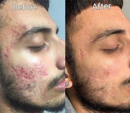 Aobenz Dark Spot Remover