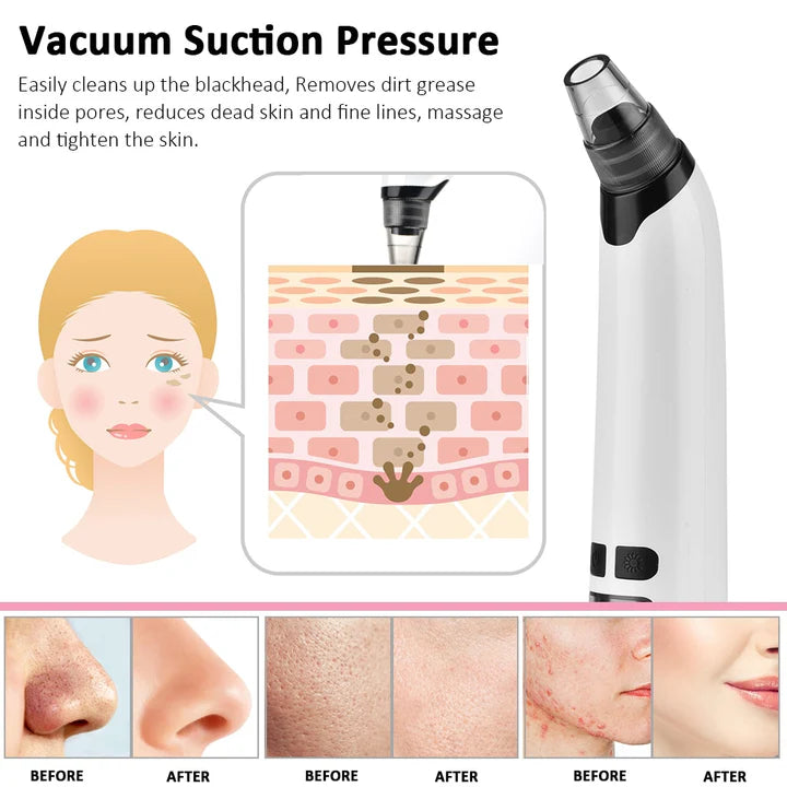 Imported Blackhead Remover