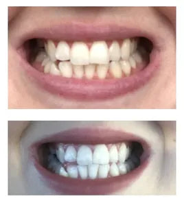 HiSmile V34™ – No More Yellow Stains, Just Bright Smiles